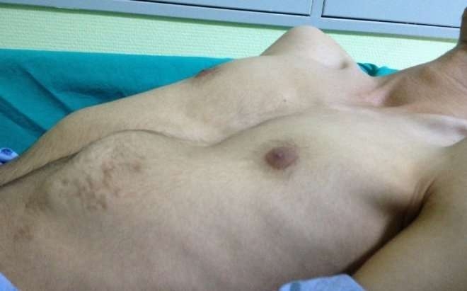 Pectus Excavatum